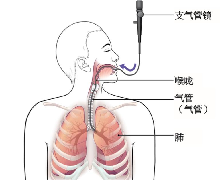 電子支氣管鏡卓越品質：為呼吸健康保駕護航