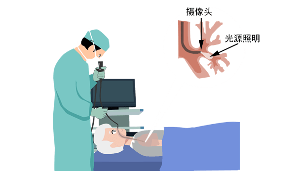 電子支氣管鏡可以應用在臨床哪些科室呢.png